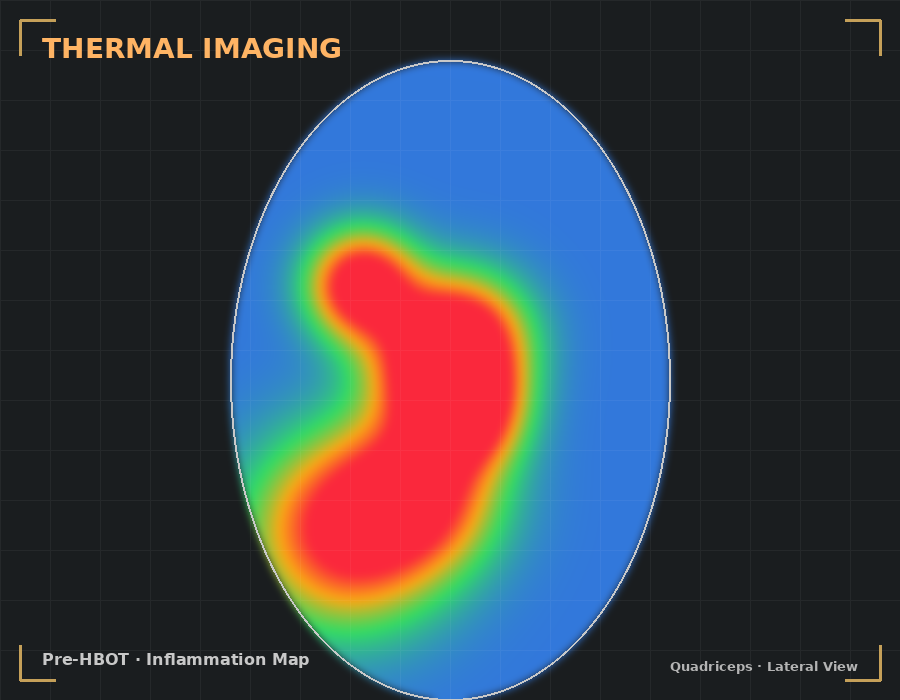 Pre-HBOT thermal imaging showing high muscle inflammation in quadriceps