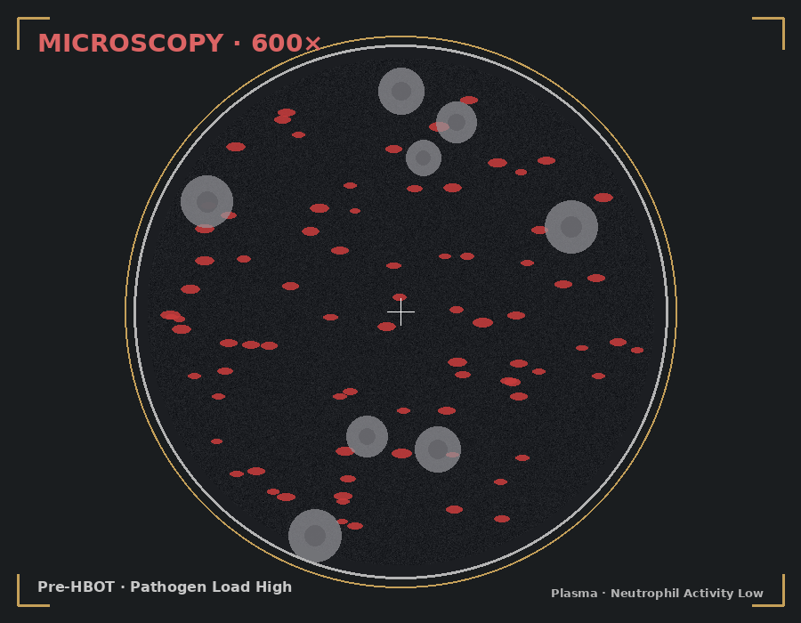 Pre-HBOT microscopy showing high pathogen load and low neutrophil activity in plasma